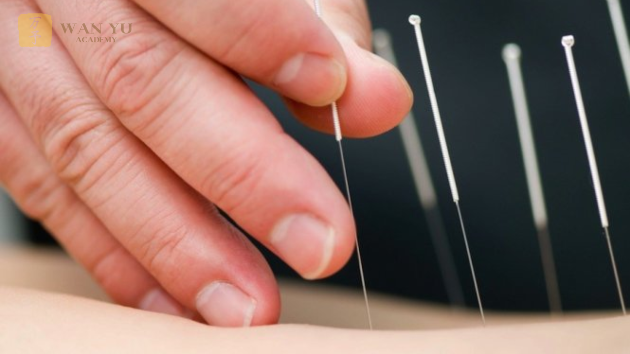 Trong thời đại hiện nay, khi nhu cầu chăm sóc sức khỏe tự nhiên ngày càng tăng, châm cứu trở thành lựa chọn của nhiều người nhờ khả năng giảm đau, phục hồi chức năng và nâng cao thể trạng một cách an toàn. Được phát triển hàng nghìn năm trong Y học cổ truyền Trung Quốc, châm cứu không chỉ là kỹ thuật điều trị mà còn là nghệ thuật điều hòa “Khí” – năng lượng sống giúp cơ thể duy trì sự cân bằng.